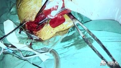 治疗肩锁关节脱位，有最好的方法吗？