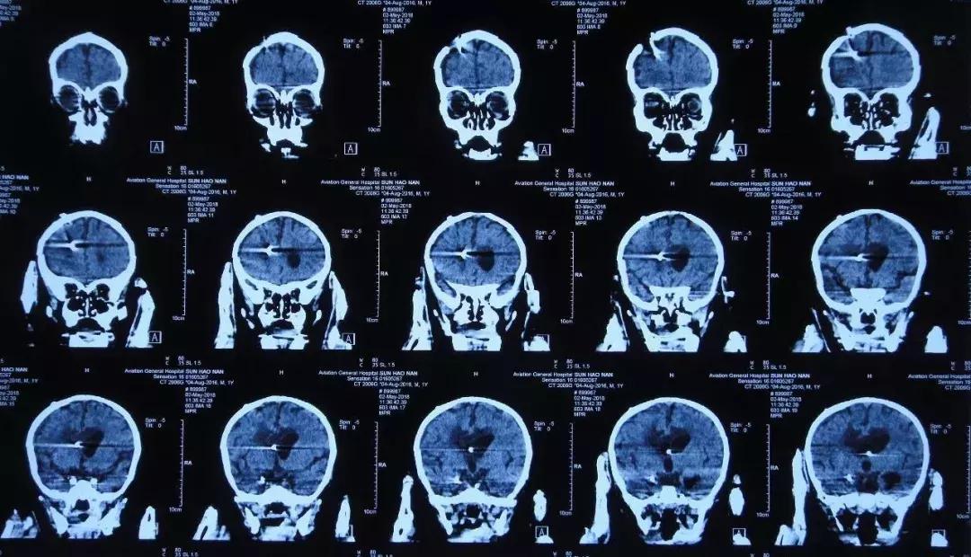 孩子脑积水反复发烧,婴儿脑积水引起发烧如何保守治疗