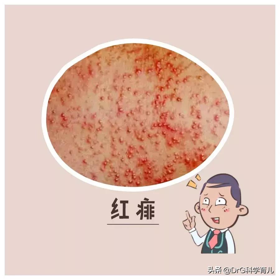 天气热了长痱子怎样快速解决,天热身上起痱子有特效药吗