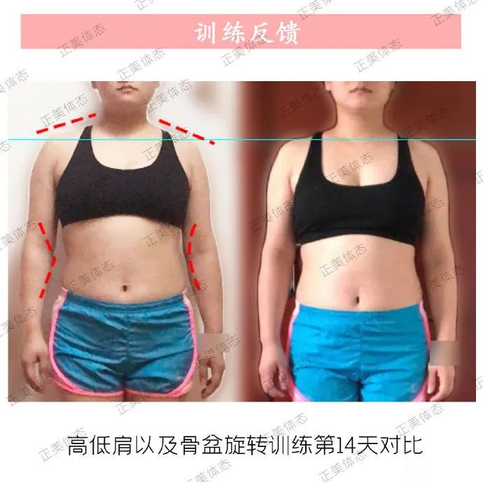 面部不对称程度怎么界定,高低肩会影响面部吗