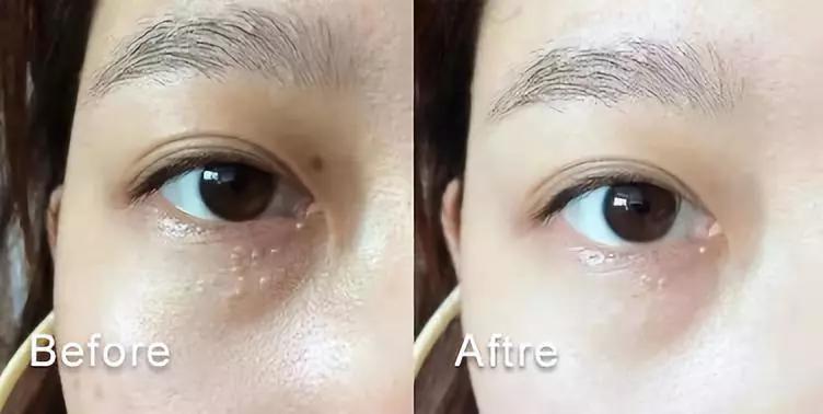 脂肪粒怎么用针挑出的,脂肪粒多久可以用针挑出来