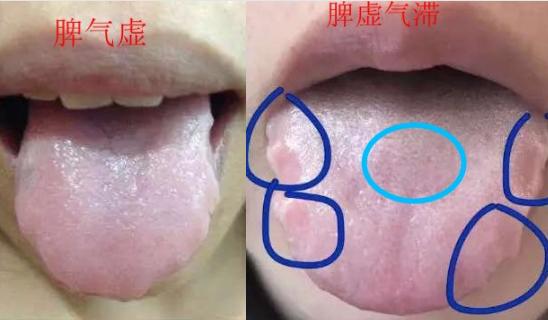 脾虚齿痕舌吃什么中成药,身上没劲乏力肚子难受怎么回事