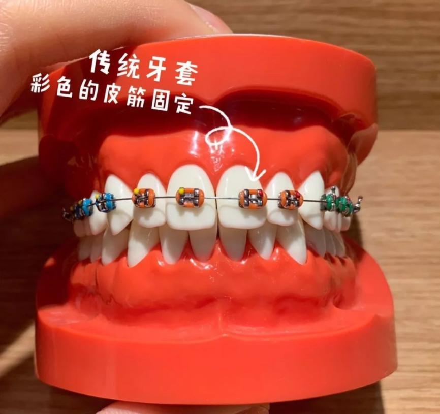 为啥进行牙齿矫正价钱不一样,最好的牙齿矫正需要多少钱