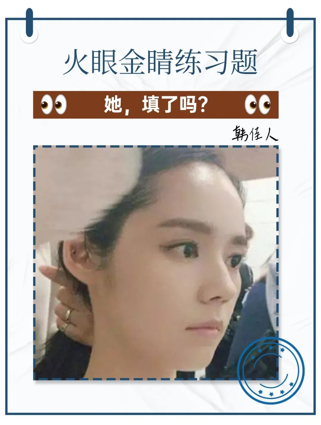 娄艺潇填充脂肪前后对比,娄艺潇填充前后对比