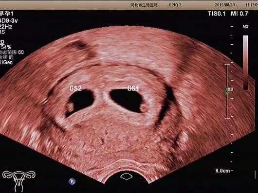 阴式彩超会碰到孩子么,经阴超声检查有害吗