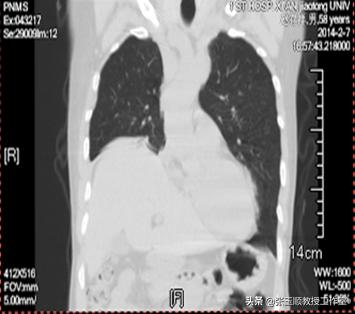 “躺平就好”四处求医愁煞人巧断病因封堵成功再登巅
