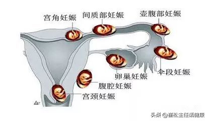 疫情有腹痛症状吗,有没有疫情期间肚子疼
