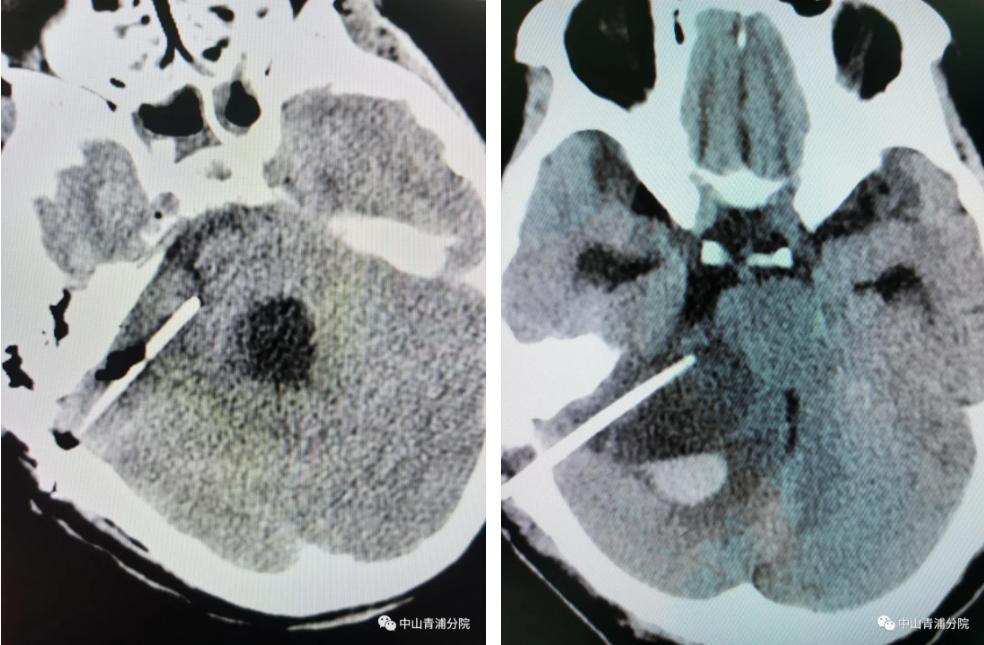 几度风雨人生,听神经瘤患者自述