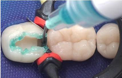 补牙有哪些流程,补牙以后需要注意什么