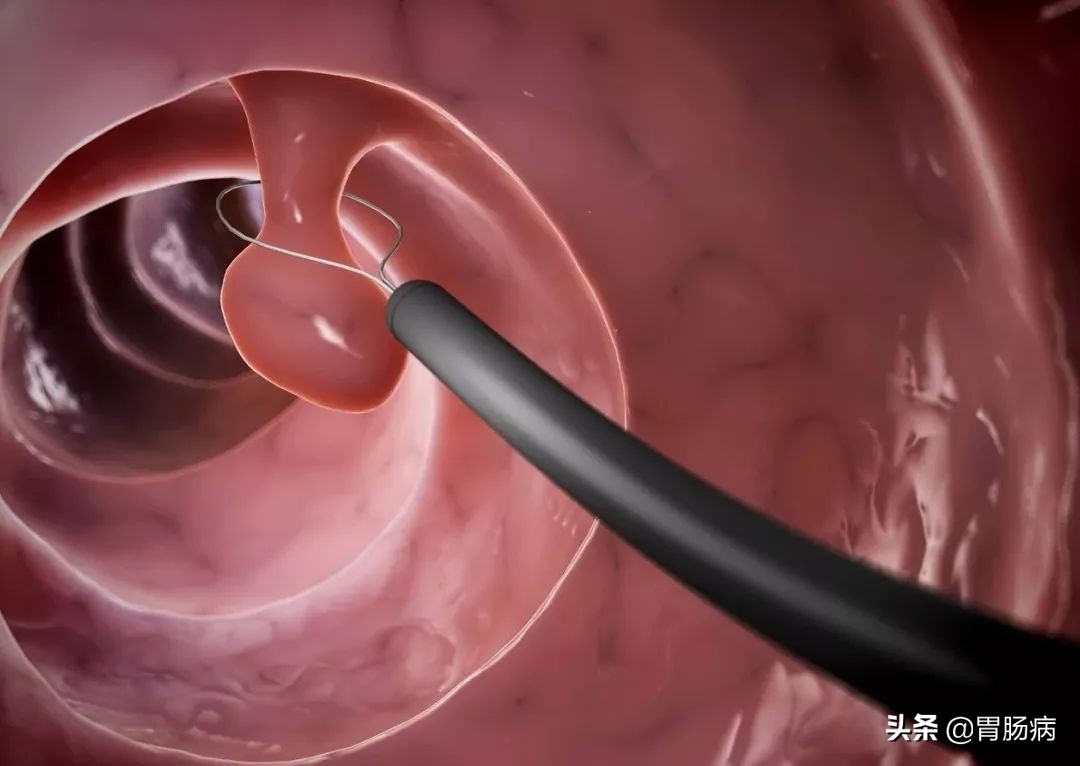 大肠息肉—藏在肚子里的定时*弹炸**，只要发现，必须格杀勿论！