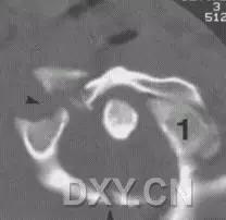 几种严重骨折医学名称,常见的骨折有哪些名称