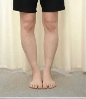 o型腿怎么走路有助于变直,成人o型腿最快变直的方法