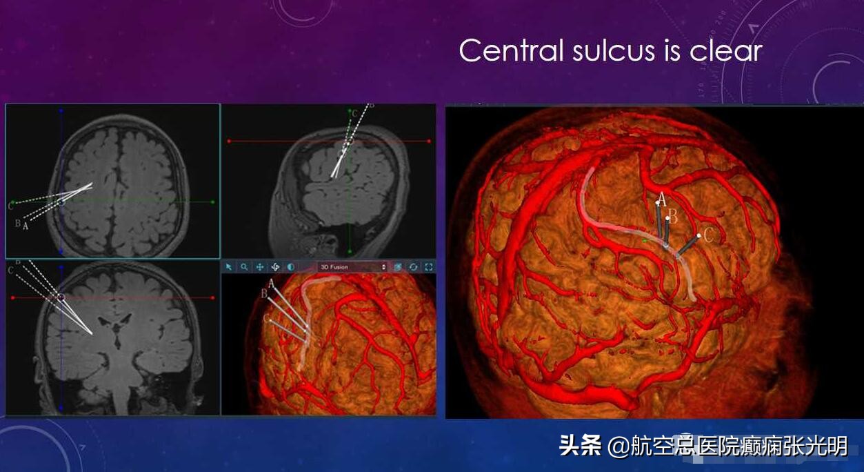 张光明左颞叶癫痫手术成功率,张光明谈治疗癫痫的方法有哪些