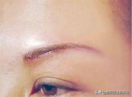 眼皮下垂做全切好还是做提眉好呢,做完提眉两年以后眼皮还会下垂吗