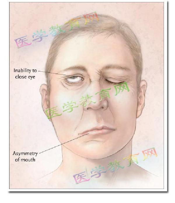 面神经炎治疗自述,面神经炎科普视频