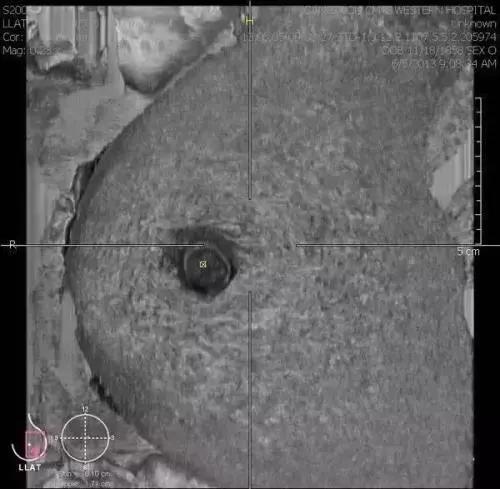 什么是乳腺纤维腺瘤？摸到乳房上有肿块，还不痛，就要小心了