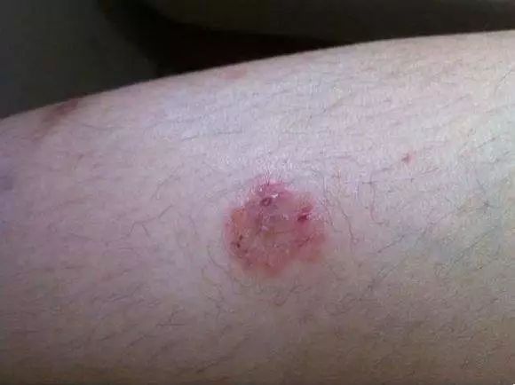 猫癣的猫生小猫怎么办,猫奶癣和猫癣的区别