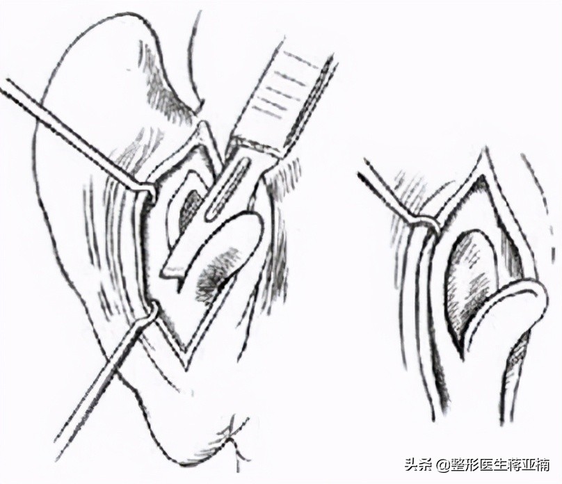 所有的耳软骨隆鼻都是假假体的么,辟谣整形传闻