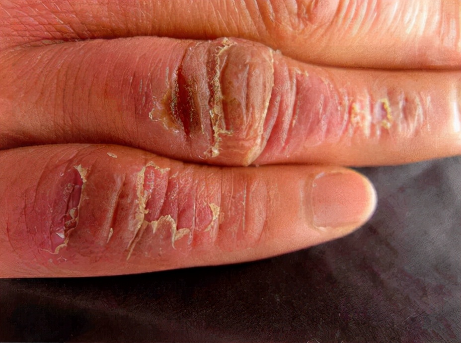 一到冬天就复发?小菌衣教你几招远离冻疮烦恼