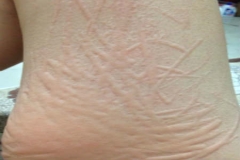 人工性荨麻疹是什么原因导致,人工性荨麻疹是什么原因导致的