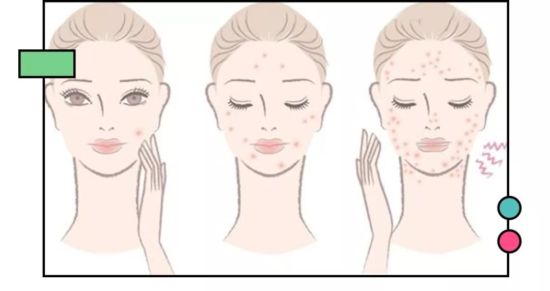 痘印多久才能消如何快速消除痘印,如何有效祛痘印看完你就知道了