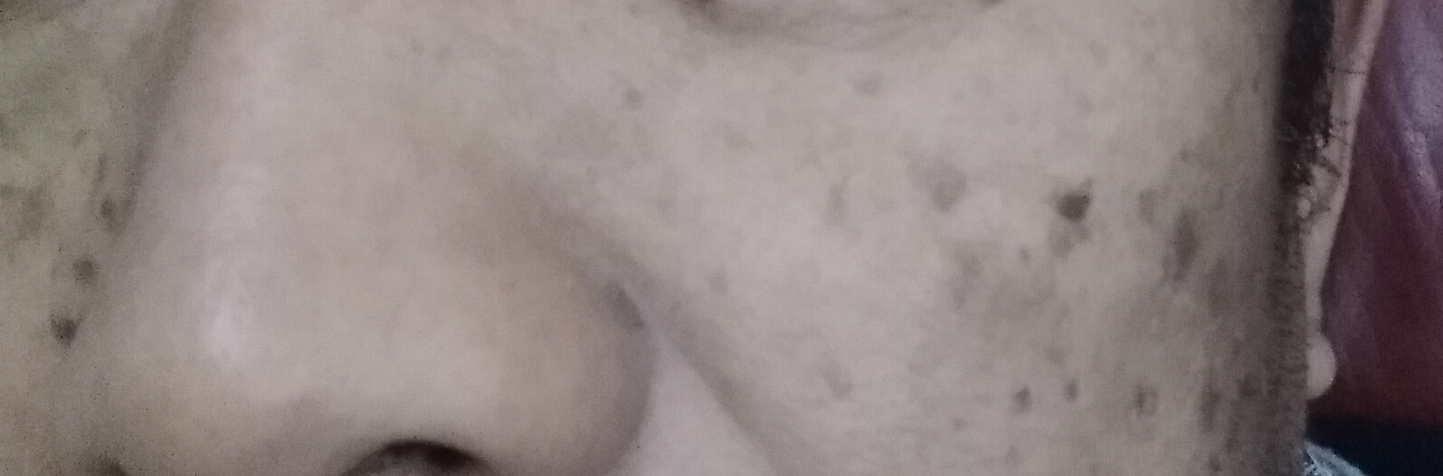 脸上被太阳晒的黑斑怎么去除,脸上长黑斑怎么去除最快方法