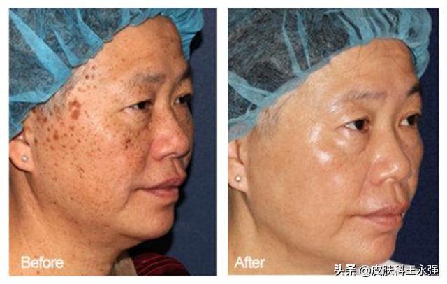 怎样可以快速去掉皮肤的老年斑,有什么办法把老年斑去掉