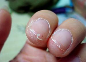 指甲盖被劈了咋办,指甲盖长劈了一半