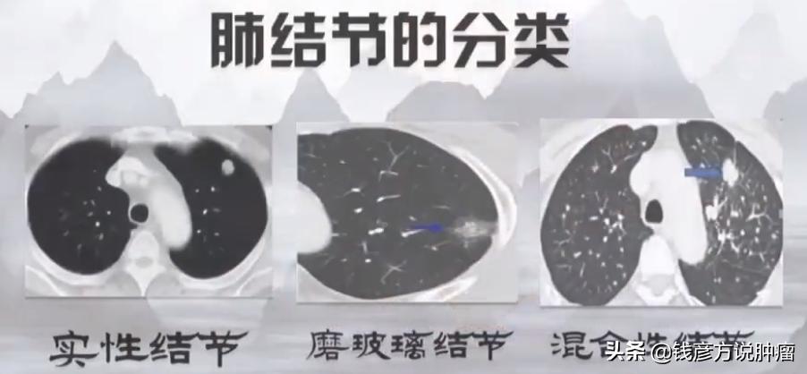 经历3次癌症手术的报道,经历两次肿瘤化疗