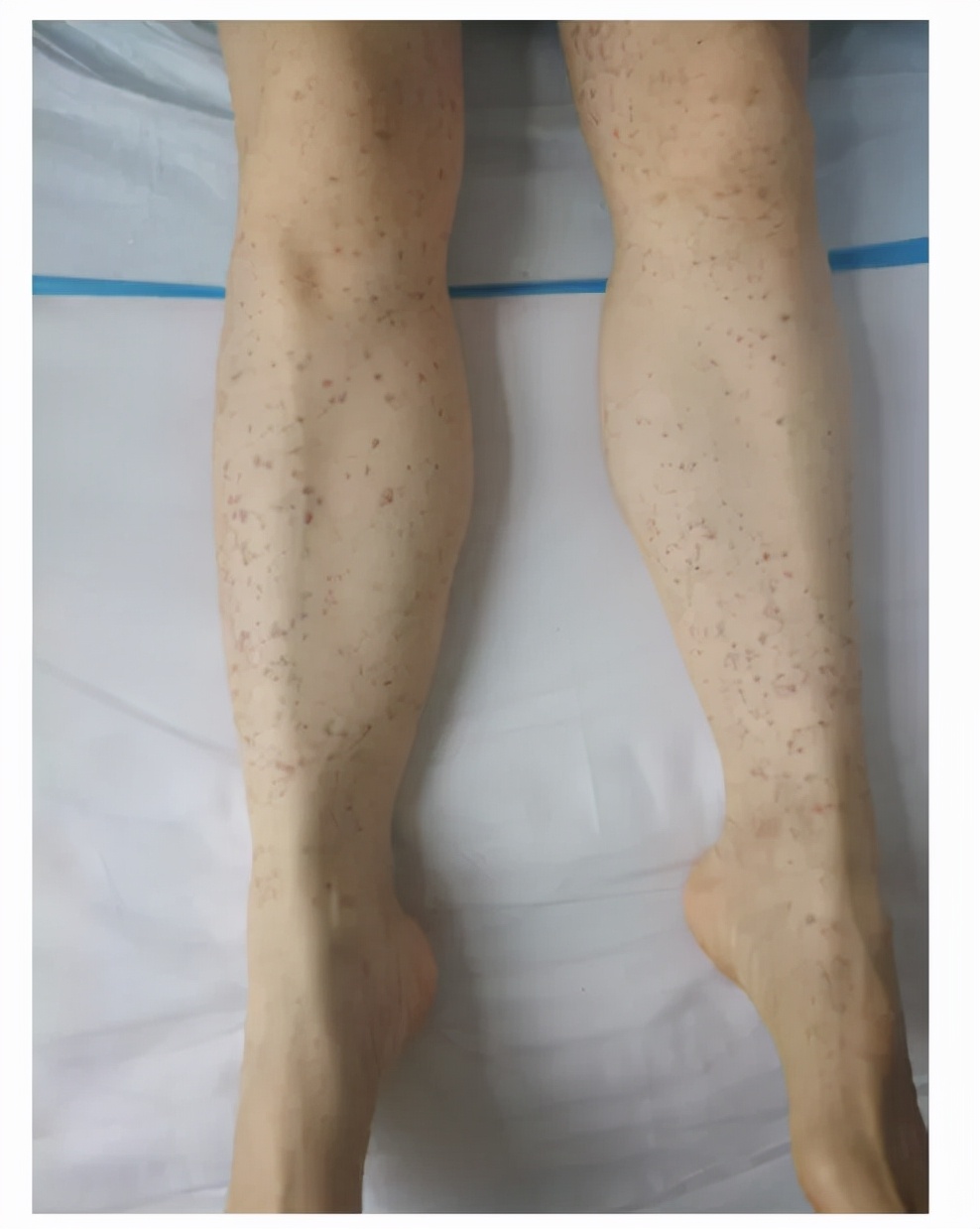 男童大腿两侧出现了红疹,小男孩腿两边长疹子怎么用药