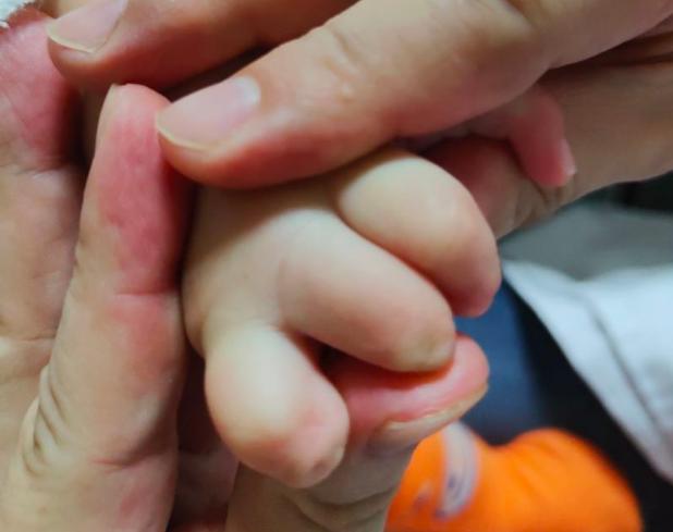 并指畸形免植皮案例,并指畸形