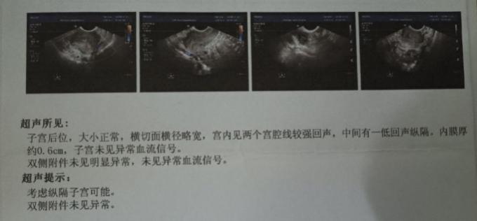 纵膈子宫可以一面放一个胚胎么,纵膈子宫可以剖腹产吗