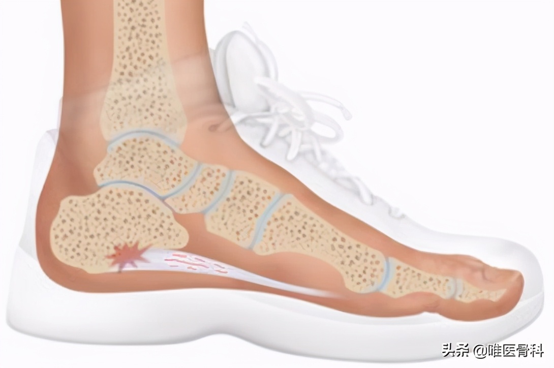 40-60岁脚后跟疼吃什么药,40-60岁脚后跟疼有啥办法