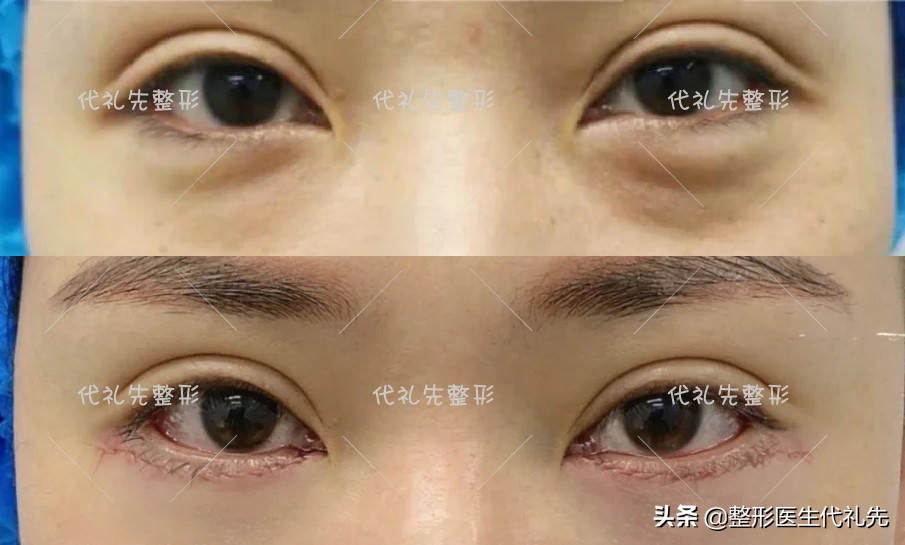 聊一聊35岁外切祛眼袋案例,为什么选择了外切而没有内切祛眼袋