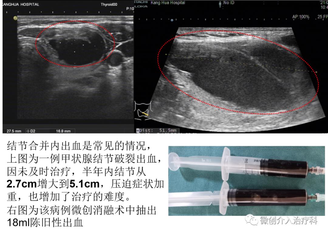 哈尔滨微创消融甲状腺结节哪家好,甲状腺结节微创消融术的过程