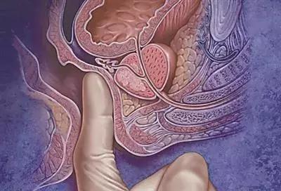 这一项“羞羞”的检查，2分钟查出直肠癌，可惜好多人都不做