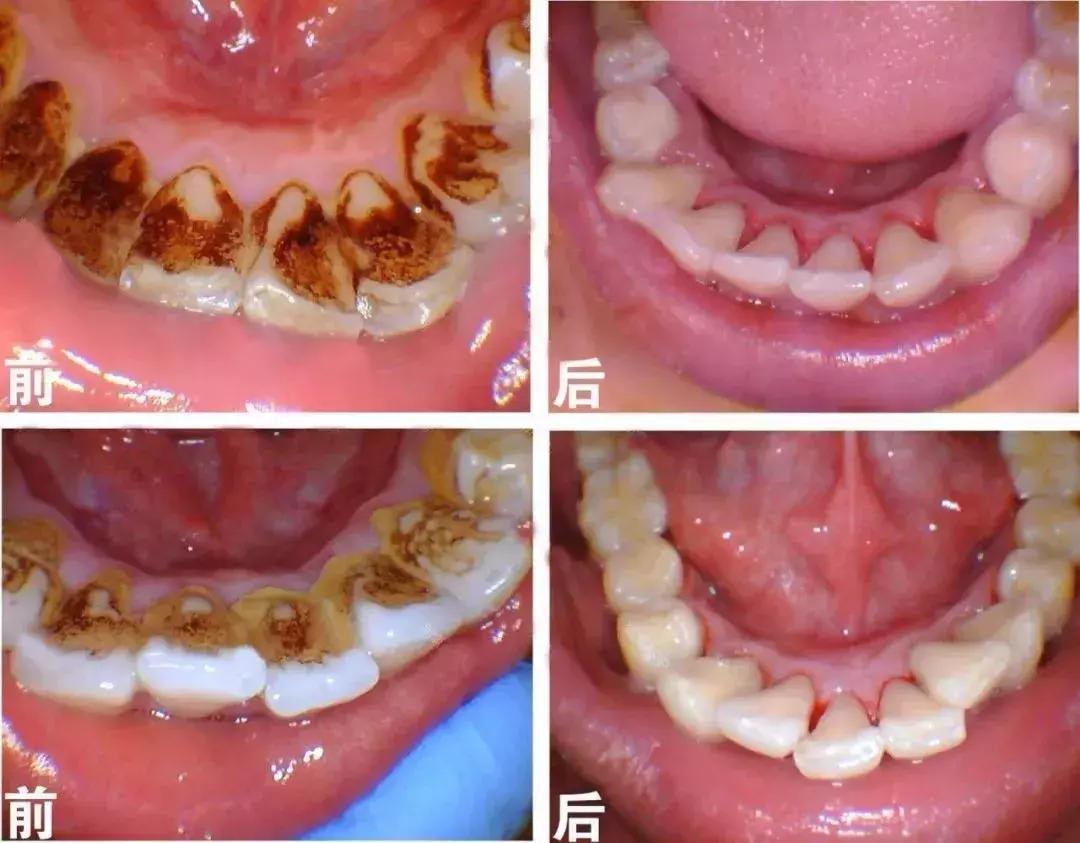 当牙齿出现小白点应该怎么办,当牙齿有黑线条