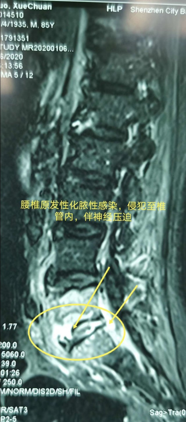 牙齿不好引发的疾病视频,牙齿有问题不做根管治疗会怎么样