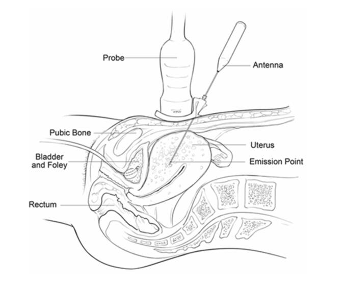 子宫肌瘤微创后月经量大有血块,严重贫血子宫肌瘤手术风险大不大