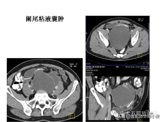 阑尾炎课件,阑尾炎的超声课件