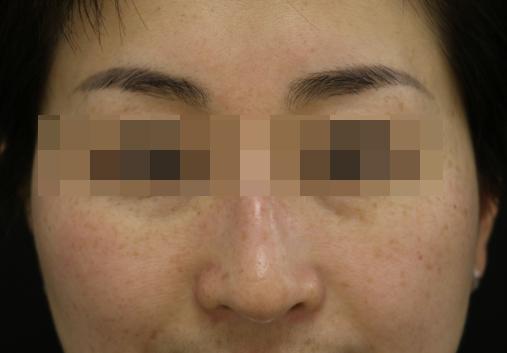 褐斑可以通过内调去掉吗,褐青色斑一个月去一次会怎样