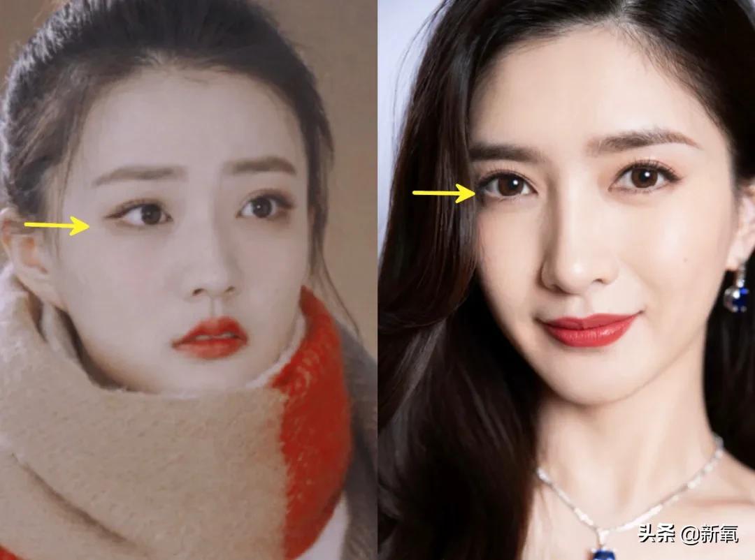 做双眼皮的姐妹还是要慎重,姐妹们你们割双眼皮多少钱