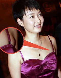 副乳里面有硬块要切除吗,副乳在腋窝下存在什么风险