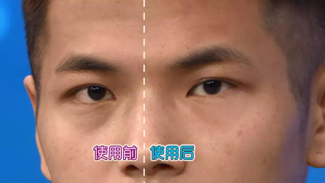 护肤黑科技顶级医美,用黑科技去除眼袋肿了十天