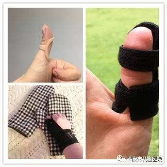 扳机指如何治疗,扳机指要怎么治疗