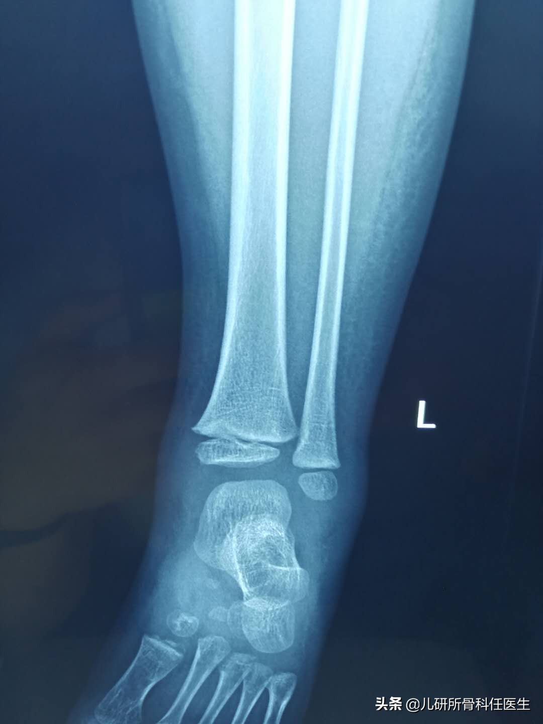 宝宝被蚊虫叮咬的正确处理方法,宝宝被蚊虫叮咬后如何正确处理