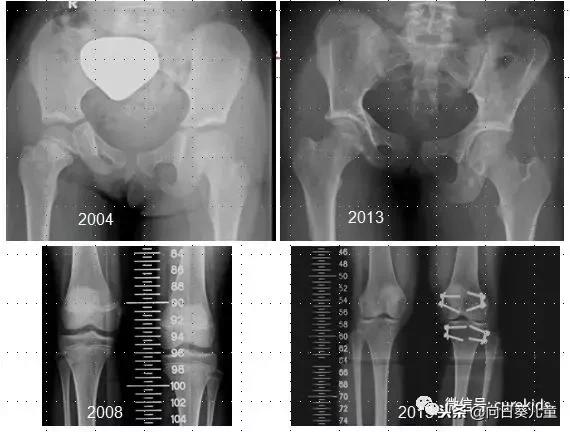质子治肿瘤怎么样,儿童肿瘤质子治疗好吗