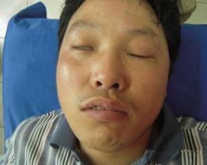 中药贴面瘫,治面瘫的特效膏药