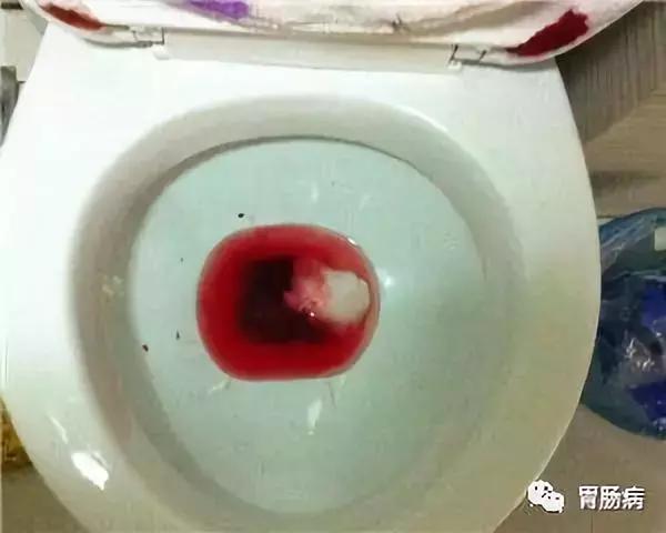 直肠癌误诊为痔疮5年,直肠癌与痔疮便血区别在哪些