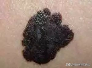 脖子发黑怎么都洗不干净怎么办,脖子发黑洗不掉像脏兮兮怎么办